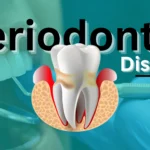 Periodontal Disease: Causes, Symptoms, Treatment & Care