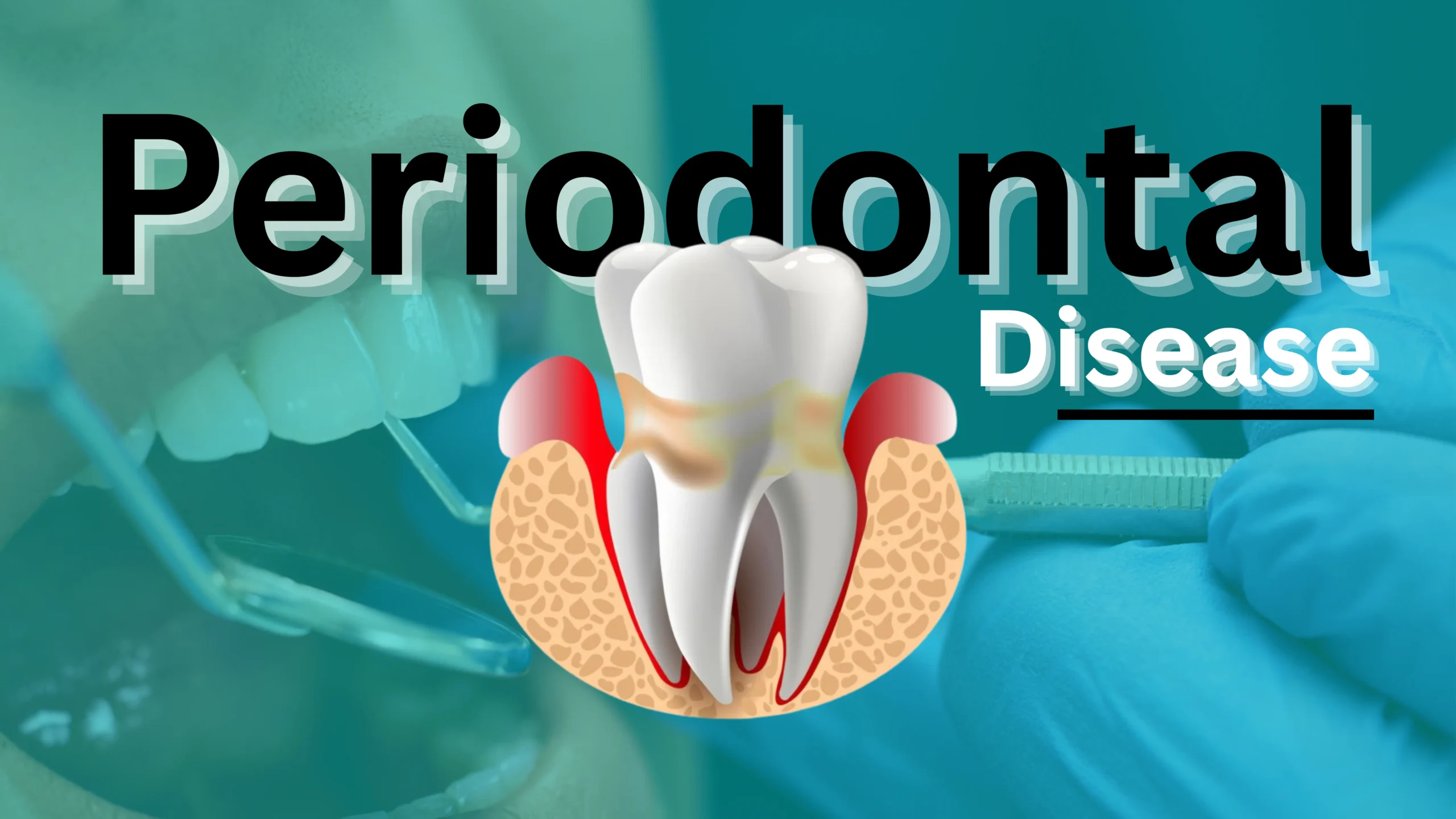 Periodontal Disease